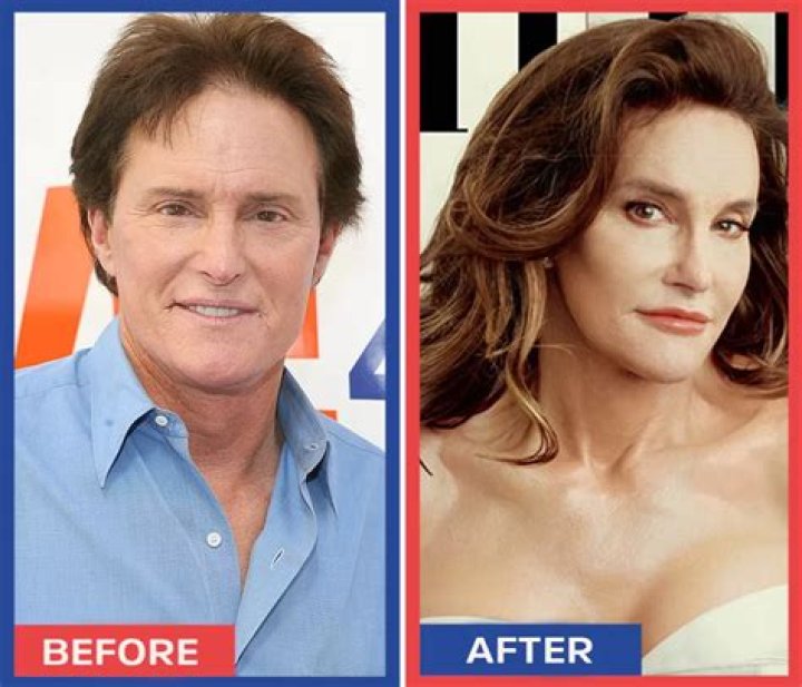 Is Bruce Jenner Using Plastic Surgery To Eventually Become a Woman?