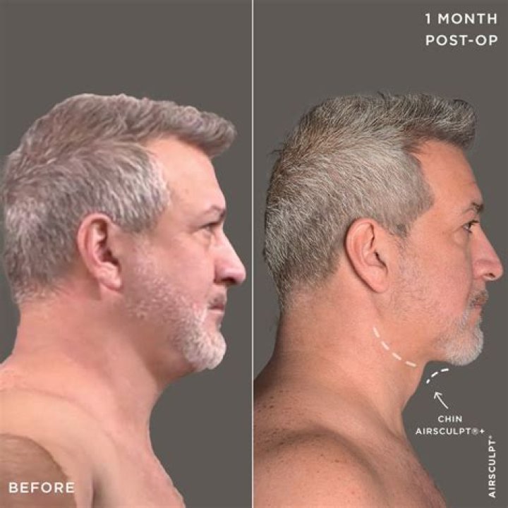 	Joey Fatone opens up about his hair plugs and fat removal procedures	