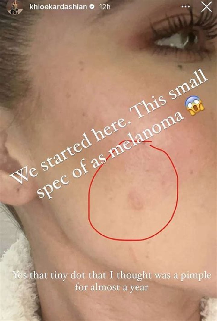 Khloé Kardashian Had Surgery to Remove Melanoma