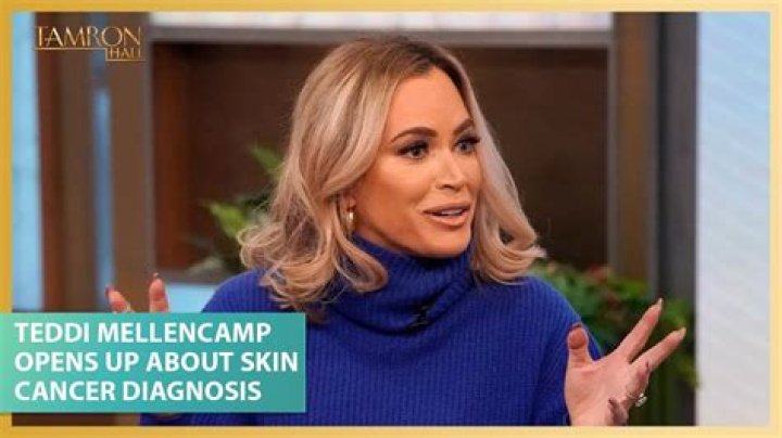 Teddi Mellencamp Diagnosed With Stage 2 Skin Cancer